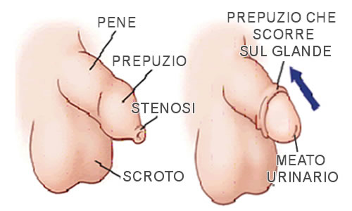 fimosi-prepuzioplastica