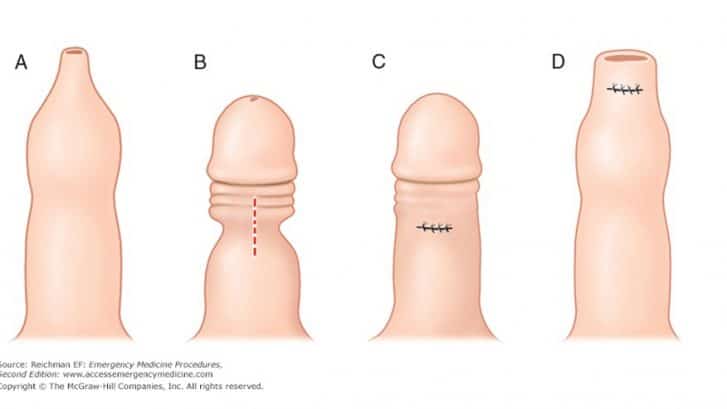 prepuzioplastica-vs-circoncisione-fimosi