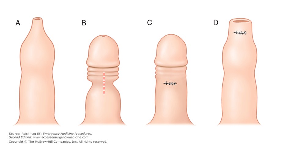 prepuzioplastica-vs-circoncisione-fimosi