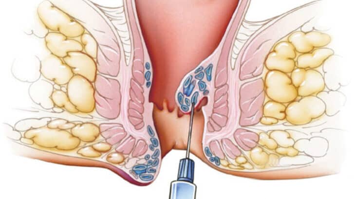 Scleroterapia-emorroidi-endosclerosi con mousse