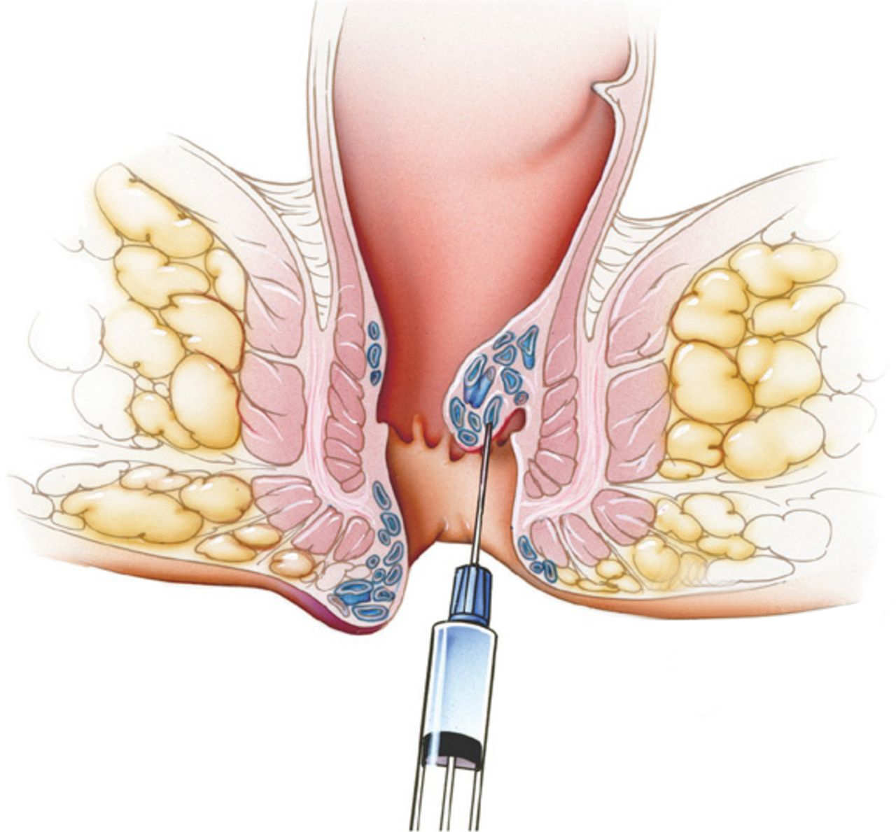 Scleroterapia-emorroidi-endosclerosi con mousse